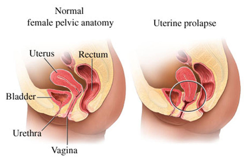 uterine prolapse