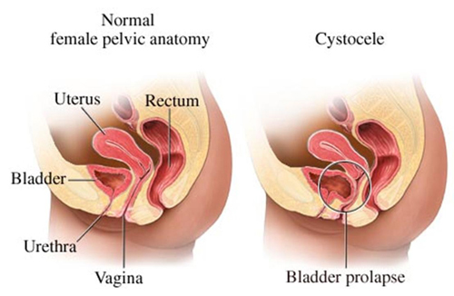 cystocele