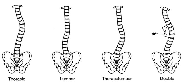 Image Source: http://www.niams.nih.gov/health_info/scoliosis/scoliosis_qa.pdf