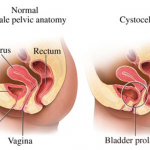 prolapse-cystocele1